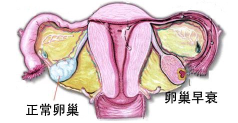 正常卵巢与卵巢早衰对比图